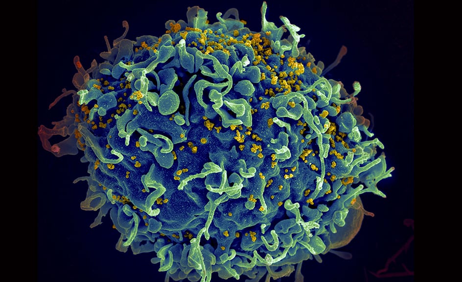 Sao Paulo Patient ‘cured’ of HIV